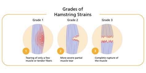 test for hamstring tear|how to grade hamstring strain.